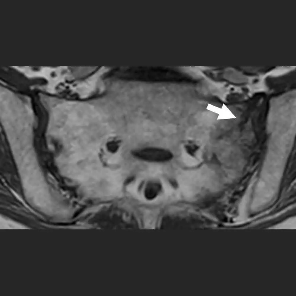 MRT-Aufnahme des Iliosakralgelenkes - Fraktur des Kreuzbeins bei Osteoporose