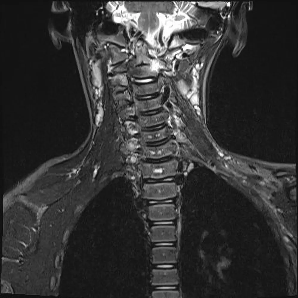 Kinder MRT Halswirbelsäule. Kindliche Arthritis der oberen Halswirbelsäule mit Fehlstellung.