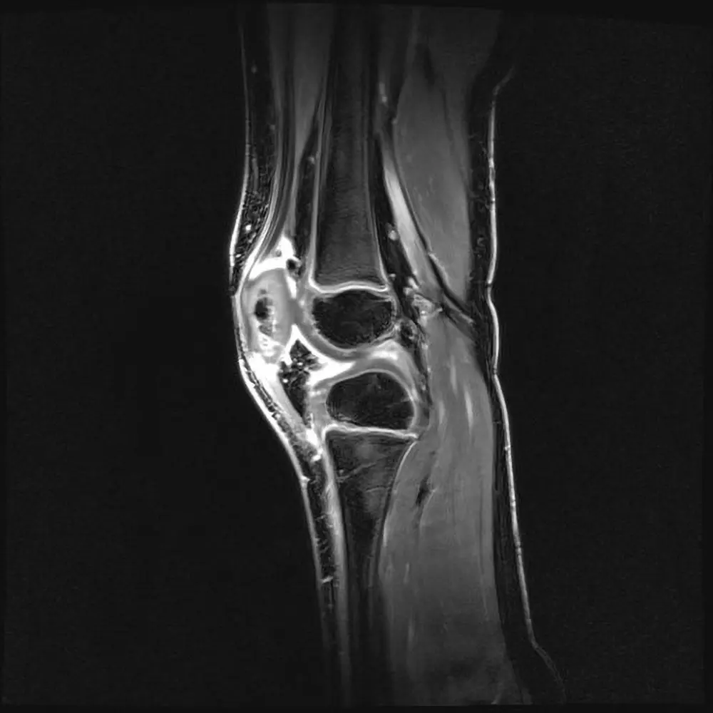 Kinder MRT Knie nach Kontrastmittel. Kindliche Arthritis.