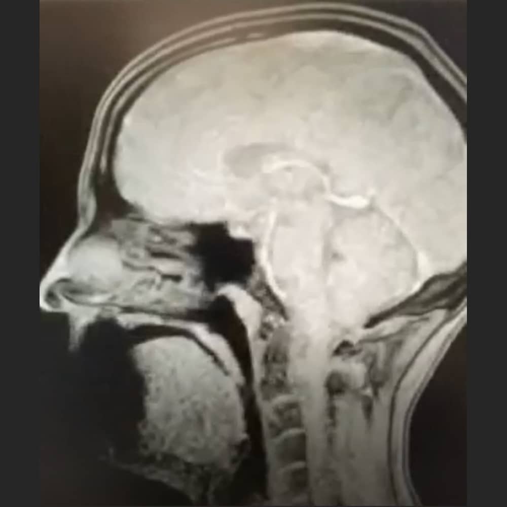 MRT Bild des Halses bei einer Untersuchung wegen Schluckstörungen