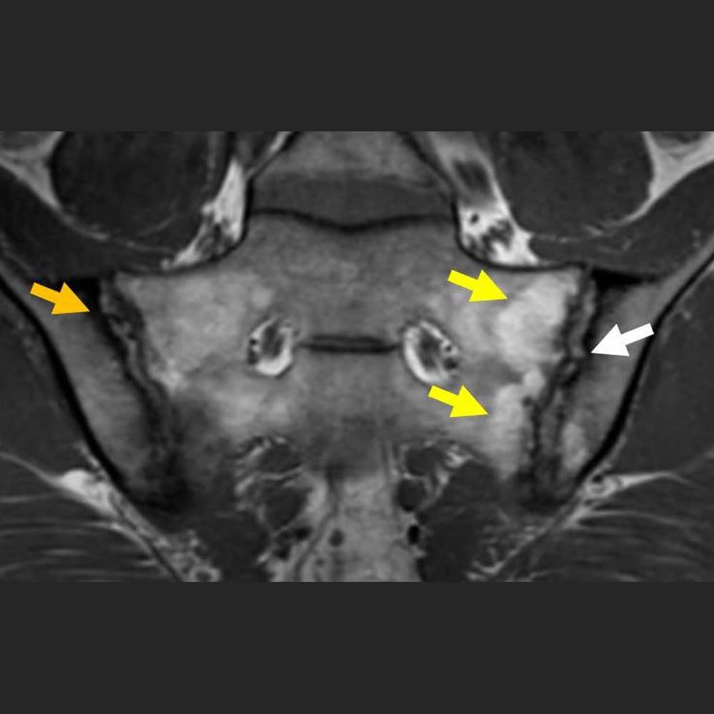 MRT-Aufnahme einer Entzündung (Arthritis) des Iliosakralgelenkes bei M. Bechterew T1 Sequenz