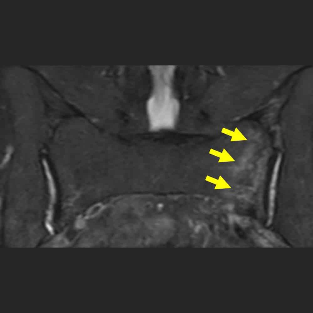 MRT-Aufnahme einer Fraktur des Kreuzbeins bei Osteoporose