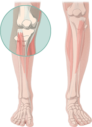 Illustration des menschlichen Knies bei ARISTRA