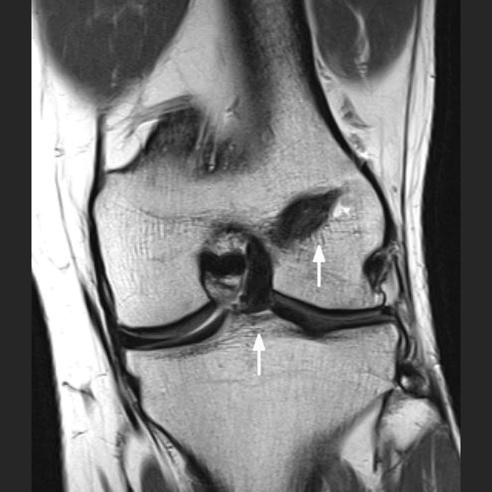 MRT-Aufnahme des Knie nach einem Kreuzbandriss