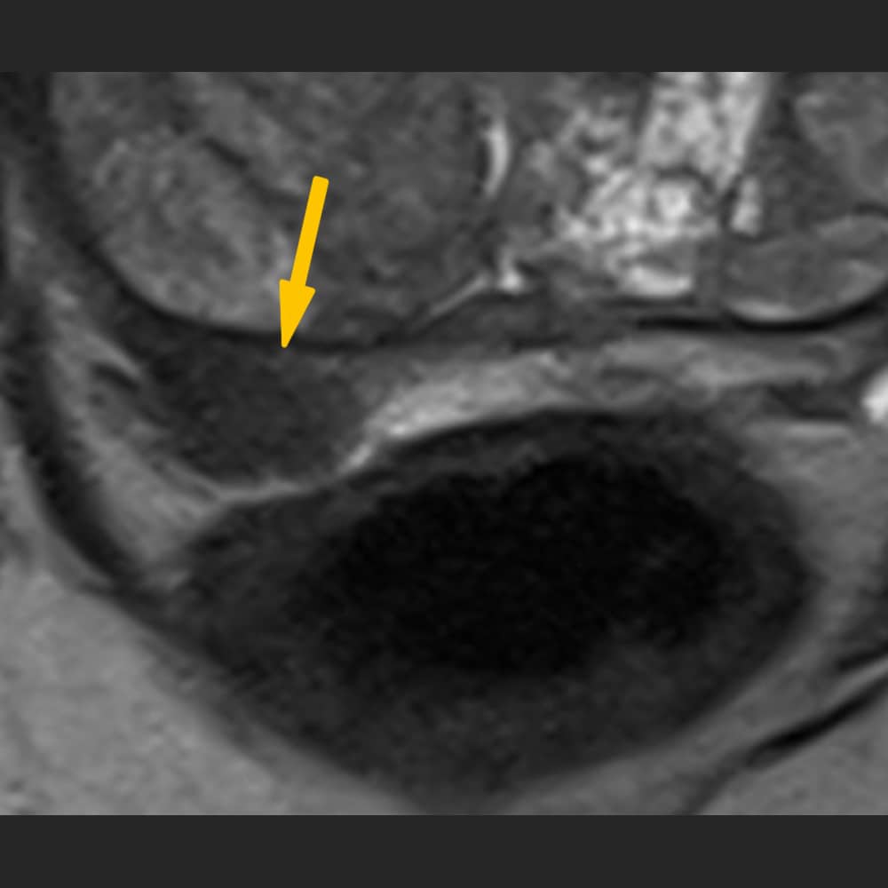 Vergrösserung im Prostata MRI