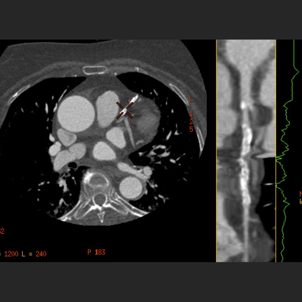 Cardio CT mit Stenose der linken Koronararterie bei Koronarsklerose