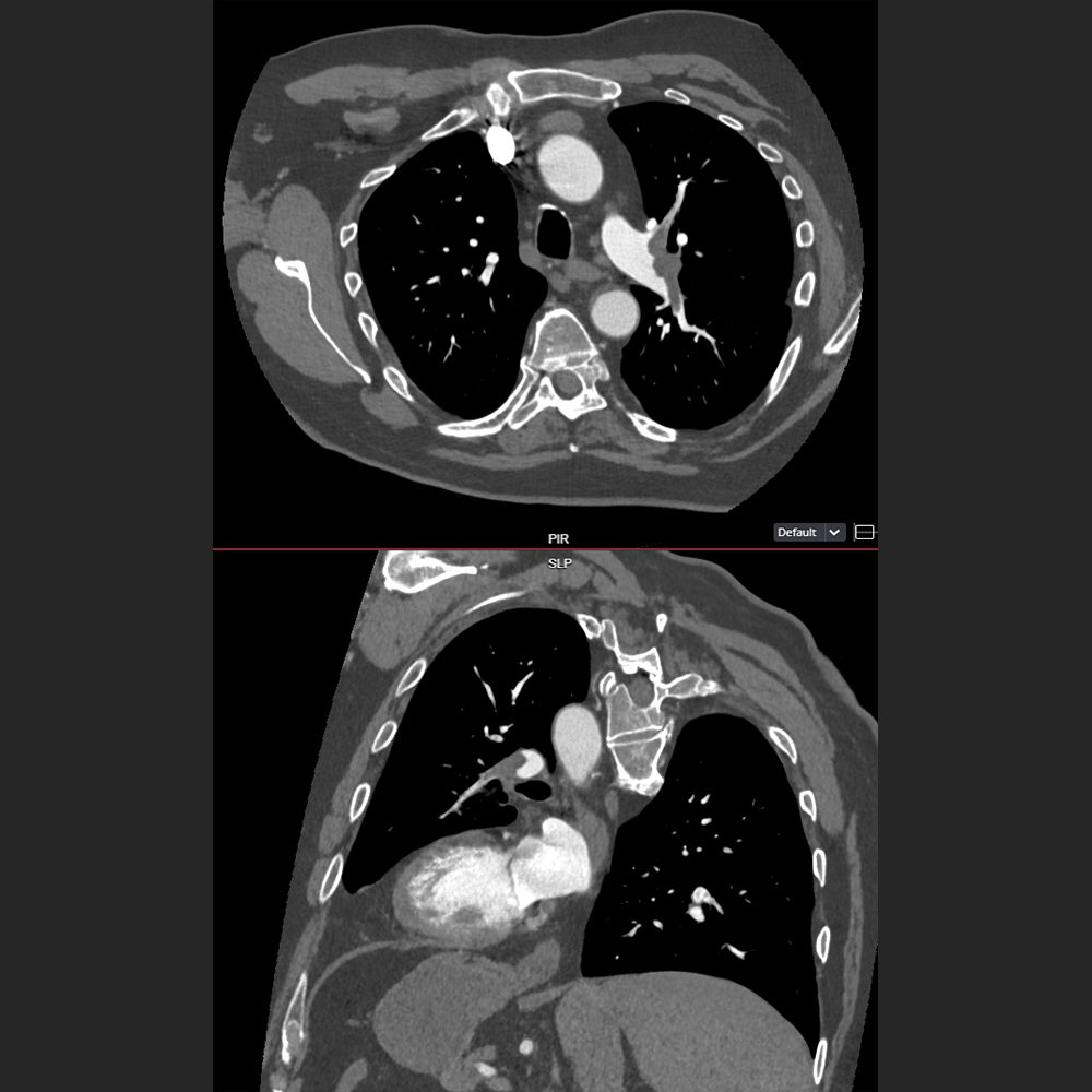Computertomographie der Lunge mit Embolien
