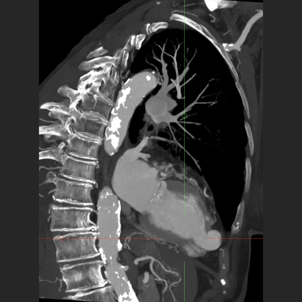 Herz CT mit aneurysmatischer Erweiterung der Herzspitze bei Zustand nach Myokardinfarkt