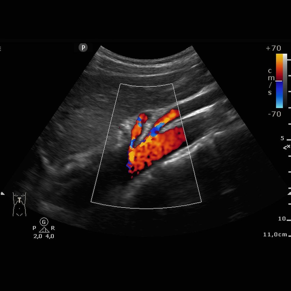 Ultraschall der Aorta